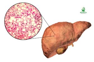 Apakah Hepatitis Berbahaya
