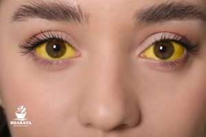 jaundice