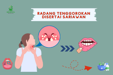 Radang Tenggorokan dan disertai Sariawan distributor bharata herbal